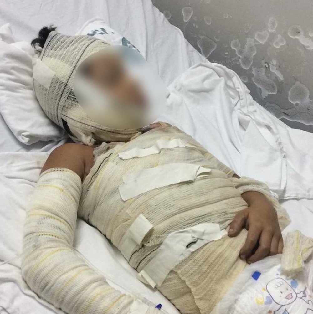 Menino tem metade do corpo queimado ao tentar fazer pipoca com irmão em MT