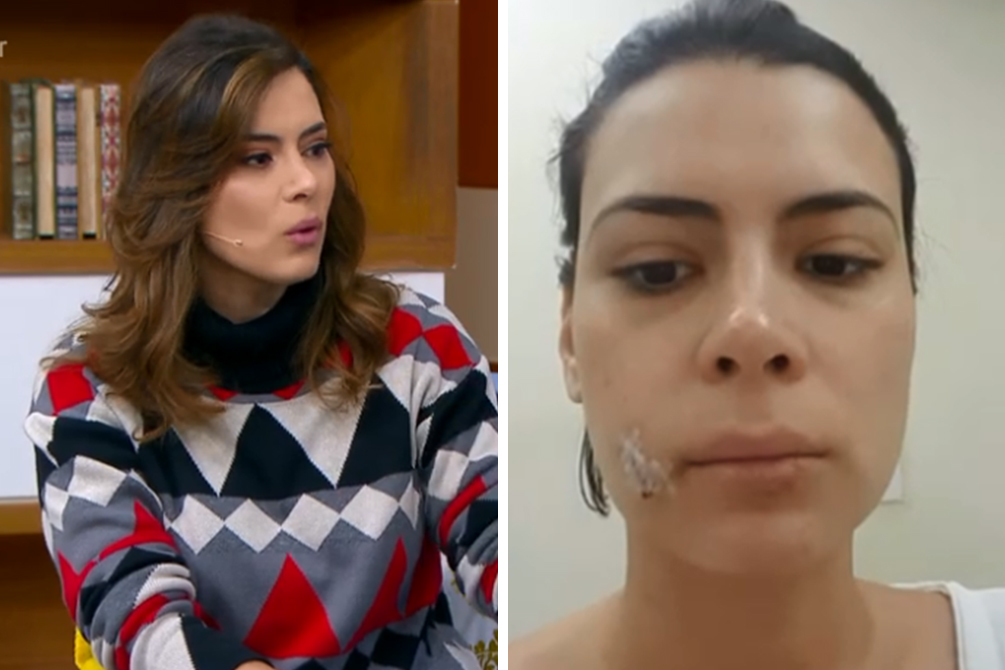 Apresentadora, Michelle Loreto revela mordida da cadela de estimação