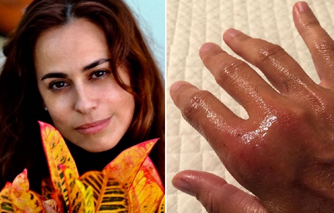 Daniela Escobar revela que quase amputou a mão após mordida de gato