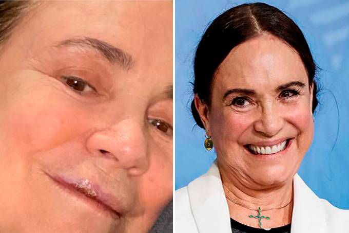 Regina Duarte tropeça em calçada, quebra três dentes e passa por cirurgia