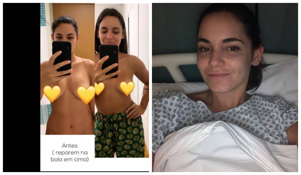 Renata Vanzetto Explante de Silicone Renata Vanzetto: antes e depois do explante de silicone compartilhado nas redes sociais