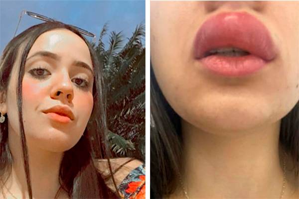 Jovem é picada por lacraia e fica com lábio inchado e falta de ar