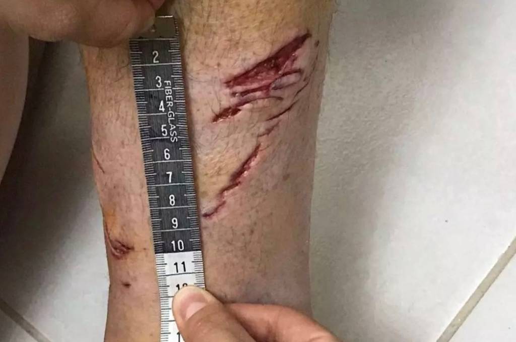 Turista francês leva mordida de tubarão em praia de Ubatuba