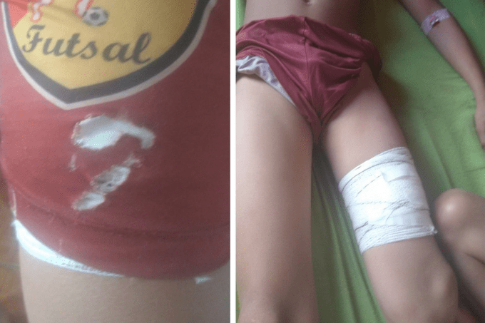 Duas fotos. À esquerda, o shorts rasgado do menino. À direita, uma parte da coxa do menino enfaixada sobre o corte do tubarão.
