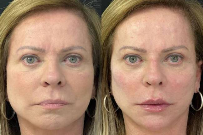 Cristina Rocha: antes e depois de harmonização facial Cristina Rocha: antes e depois de harmonização facial