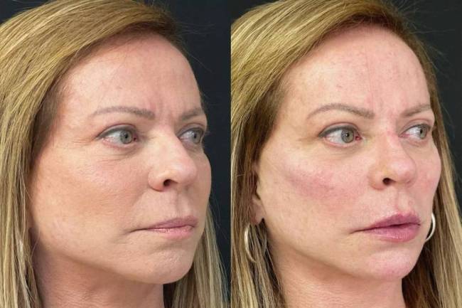 Cristina Rocha: antes e depois de harmonização facial Cristina Rocha: antes e depois de harmonização facial