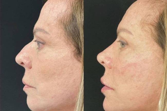 Cristina Rocha: antes e depois de harmonização facial Cristina Rocha: antes e depois de harmonização facial