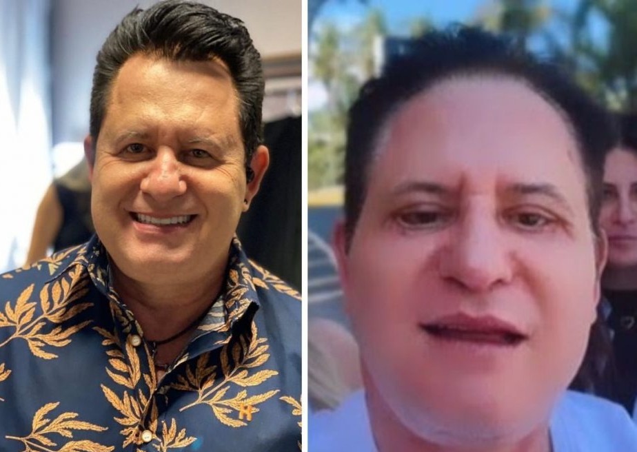 Montagem com duas fotos de Marrone, antes e depois dos procedimentos