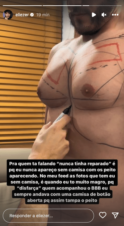 a imagem mostra as mamas de eliezer com marcações de caneta feitas por um médico cuja mão aparece na foto